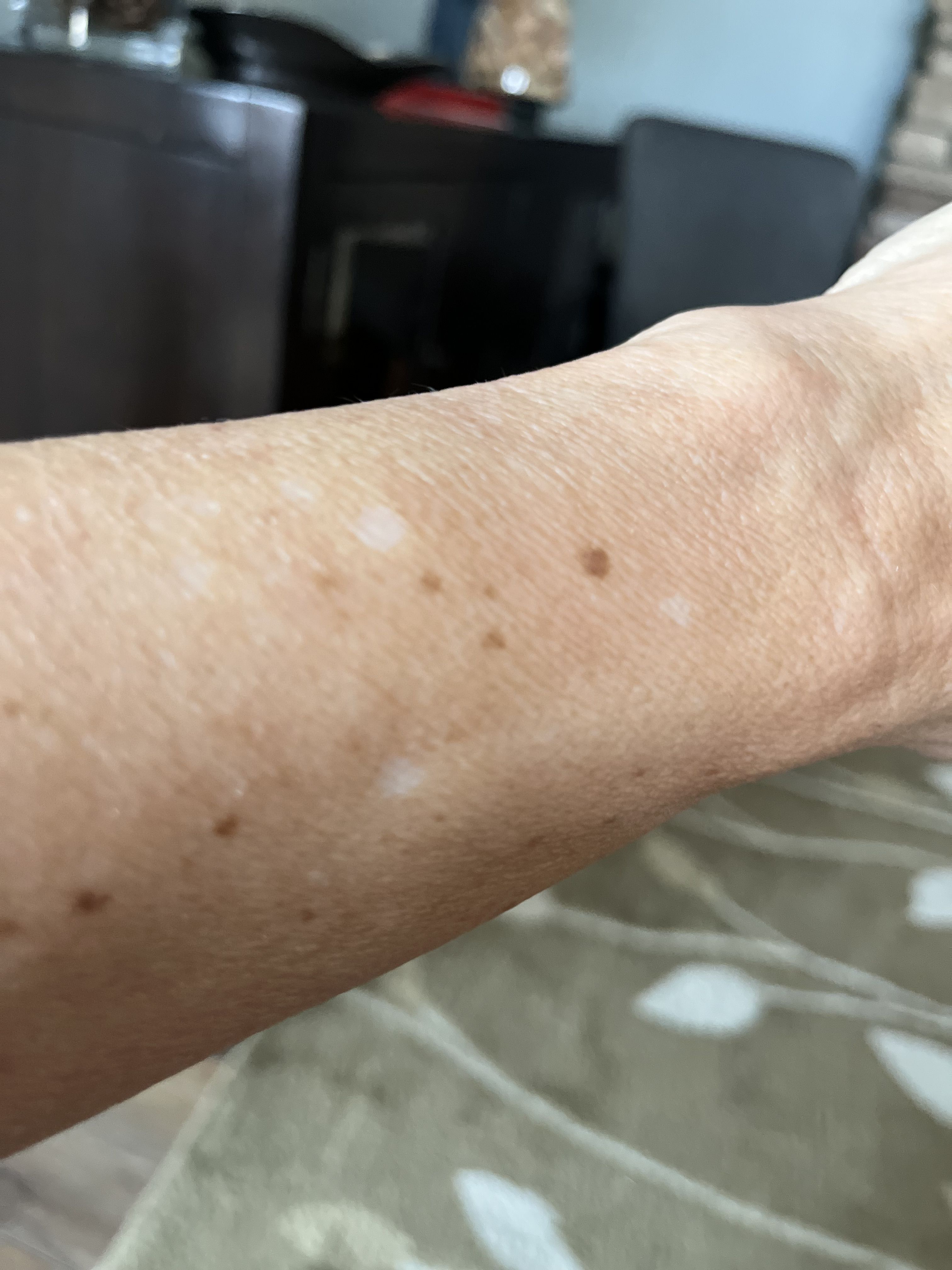 Do you have age spots? - The Café - Square Wheels Cycling
